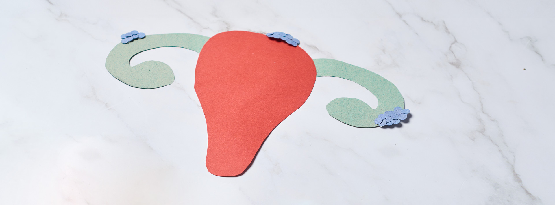 Ενδομητρίωση